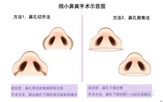 鼻综合手术两个月后鼻头过大的现象解析