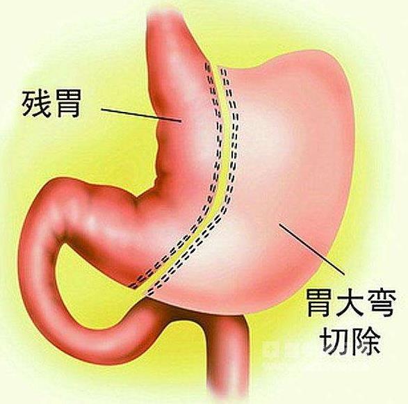 如何一个月瘦8斤，实现健康减重的方法